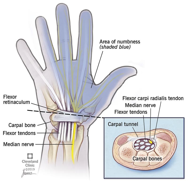 Choosing mountain bike grips for large hands could help to avoid carpal tunnel syndrome.